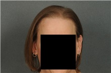 Hair Transplant After Photo by Ellen Janetzke, MD; Bloomfield Hills, MI - Case 33899