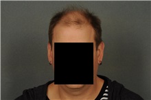 Hair Transplant Before Photo by Ellen Janetzke, MD; Bloomfield Hills, MI - Case 33899