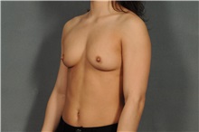 Breast Reduction After Photo by Ellen Janetzke, MD; Bloomfield Hills, MI - Case 33901