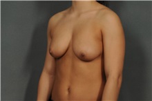Breast Reduction Before Photo by Ellen Janetzke, MD; Bloomfield Hills, MI - Case 33901