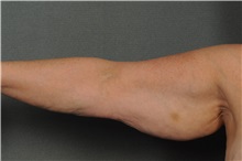 Arm Lift Before Photo by Ellen Janetzke, MD; Bloomfield Hills, MI - Case 34171