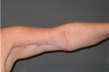 Arm Lift After Photo by Ellen Janetzke, MD; Bloomfield Hills, MI - Case 34171