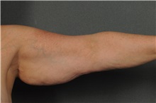 Arm Lift Before Photo by Ellen Janetzke, MD; Bloomfield Hills, MI - Case 34171