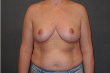 Breast Reduction After Photo by Ellen Janetzke, MD; Bloomfield Hills, MI - Case 35559