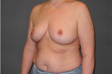 Breast Reduction After Photo by Ellen Janetzke, MD; Bloomfield Hills, MI - Case 35559