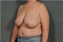 Breast Reduction Before Photo by Ellen Janetzke, MD; Bloomfield Hills, MI - Case 35559