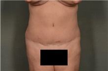 Tummy Tuck After Photo by Ellen Janetzke, MD; Bloomfield Hills, MI - Case 35560