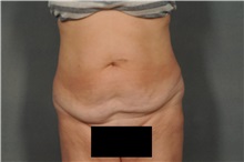 Tummy Tuck Before Photo by Ellen Janetzke, MD; Bloomfield Hills, MI - Case 35560