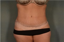 Tummy Tuck After Photo by Ellen Janetzke, MD; Bloomfield Hills, MI - Case 35562