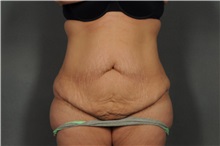 Tummy Tuck Before Photo by Ellen Janetzke, MD; Bloomfield Hills, MI - Case 35562