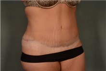 Tummy Tuck After Photo by Ellen Janetzke, MD; Bloomfield Hills, MI - Case 35562