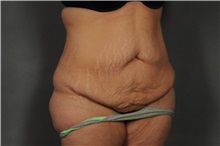 Tummy Tuck Before Photo by Ellen Janetzke, MD; Bloomfield Hills, MI - Case 35562
