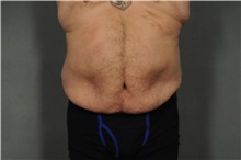 Tummy Tuck Before Photo by Ellen Janetzke, MD; Bloomfield Hills, MI - Case 35817
