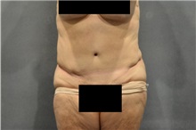Tummy Tuck After Photo by Ellen Janetzke, MD; Bloomfield Hills, MI - Case 35818
