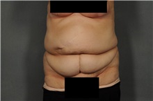 Tummy Tuck Before Photo by Ellen Janetzke, MD; Bloomfield Hills, MI - Case 35818
