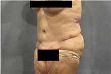 Tummy Tuck After Photo by Ellen Janetzke, MD; Bloomfield Hills, MI - Case 35818