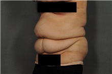 Tummy Tuck Before Photo by Ellen Janetzke, MD; Bloomfield Hills, MI - Case 35818