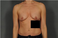 Breast Augmentation Before Photo by Ellen Janetzke, MD; Bloomfield Hills, MI - Case 35820
