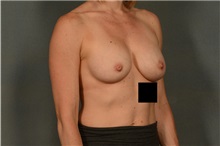 Breast Augmentation After Photo by Ellen Janetzke, MD; Bloomfield Hills, MI - Case 35820