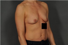 Breast Augmentation Before Photo by Ellen Janetzke, MD; Bloomfield Hills, MI - Case 35820