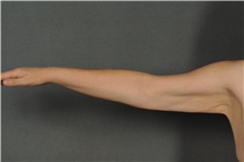 Arm Lift Before Photo by Ellen Janetzke, MD; Bloomfield Hills, MI - Case 35968