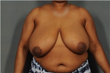 Breast Reduction Before Photo by Ellen Janetzke, MD; Bloomfield Hills, MI - Case 35969