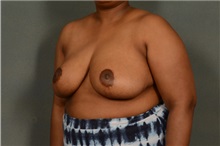 Breast Reduction After Photo by Ellen Janetzke, MD; Bloomfield Hills, MI - Case 35969