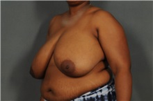 Breast Reduction Before Photo by Ellen Janetzke, MD; Bloomfield Hills, MI - Case 35969