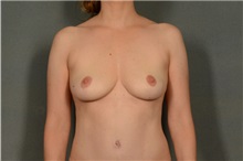 Breast Lift After Photo by Ellen Janetzke, MD; Bloomfield Hills, MI - Case 35971
