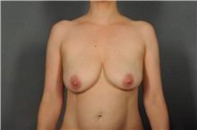 Breast Lift Before Photo by Ellen Janetzke, MD; Bloomfield Hills, MI - Case 35971