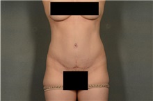 Tummy Tuck After Photo by Ellen Janetzke, MD; Bloomfield Hills, MI - Case 35972