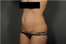 Tummy Tuck Before Photo by Ellen Janetzke, MD; Bloomfield Hills, MI - Case 35972