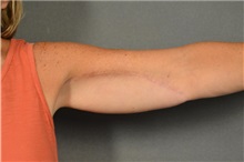 Arm Lift After Photo by Ellen Janetzke, MD; Bloomfield Hills, MI - Case 36587