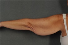 Arm Lift Before Photo by Ellen Janetzke, MD; Bloomfield Hills, MI - Case 36587