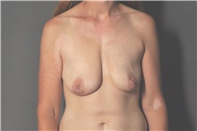 Breast Augmentation Before Photo by Ellen Janetzke, MD; Bloomfield Hills, MI - Case 36588