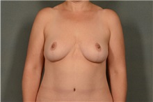 Breast Reduction After Photo by Ellen Janetzke, MD; Bloomfield Hills, MI - Case 36589