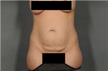 Tummy Tuck Before Photo by Ellen Janetzke, MD; Bloomfield Hills, MI - Case 36591