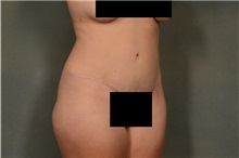 Tummy Tuck After Photo by Ellen Janetzke, MD; Bloomfield Hills, MI - Case 36591
