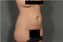 Tummy Tuck Before Photo by Ellen Janetzke, MD; Bloomfield Hills, MI - Case 36591