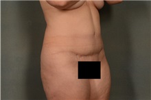 Tummy Tuck After Photo by Ellen Janetzke, MD; Bloomfield Hills, MI - Case 36593