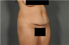 Tummy Tuck Before Photo by Ellen Janetzke, MD; Bloomfield Hills, MI - Case 36593
