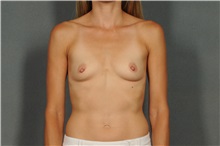 Breast Augmentation Before Photo by Ellen Janetzke, MD; Bloomfield Hills, MI - Case 36638