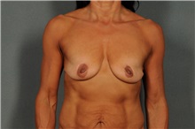 Breast Augmentation Before Photo by Ellen Janetzke, MD; Bloomfield Hills, MI - Case 36793