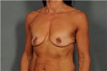 Breast Augmentation Before Photo by Ellen Janetzke, MD; Bloomfield Hills, MI - Case 36793