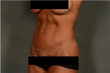 Tummy Tuck After Photo by Ellen Janetzke, MD; Bloomfield Hills, MI - Case 36794