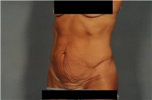 Tummy Tuck Before Photo by Ellen Janetzke, MD; Bloomfield Hills, MI - Case 36794