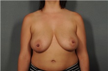 Breast Reduction Before Photo by Ellen Janetzke, MD; Bloomfield Hills, MI - Case 36797