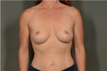 Breast Reduction After Photo by Ellen Janetzke, MD; Bloomfield Hills, MI - Case 36997
