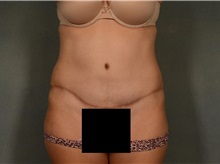 Tummy Tuck After Photo by Ellen Janetzke, MD; Bloomfield Hills, MI - Case 36998