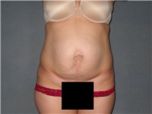 Tummy Tuck Before Photo by Ellen Janetzke, MD; Bloomfield Hills, MI - Case 36998